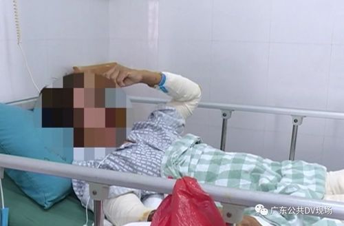 厨房意外着火 婆婆全身大面积烧伤